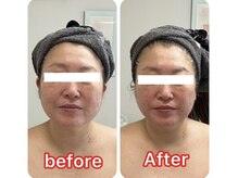 アーチ(AR-CH.)/リフティング