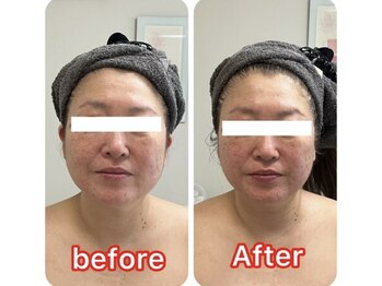 アーチ(AR-CH.)/リフティング