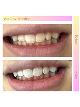 エクシアホワイトニング 京都駅前店/ホワイトニングビフォーアフター