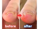 巻き爪施術一回目