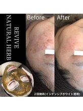 ホワイトビューティーラボ(White Beauty Lab)/次世代ハーブピーリング