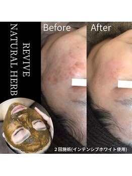 ホワイトビューティーラボ(White Beauty Lab)/次世代ハーブピーリング