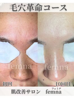 フェミナ(femna)/本気の毛穴革命