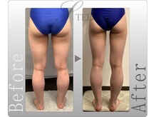 ステラ(STELLA)/下半身プレミアムの効果