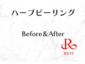 ヒーリングハーツ(Healing Hearts)/ハーブピーリングB&A