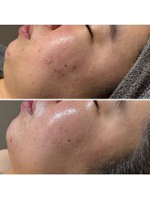 ロッタ エクリュ(Lotta ecru+)/REVI剥けないハーブピーリング