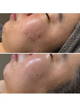 ロッタ エクリュ(Lotta ecru+)/REVI剥けないハーブピーリング