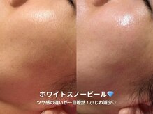 ピブ(pib.)/ホワイトスノーピール直後◎