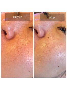 ラ ドウ 名古屋黒川店(la.dow)/広がった毛穴が…