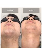 マリーローラン メンズルイズ(Marryrolan MensRuise)/メンズ脱毛【ヒゲ脱毛】