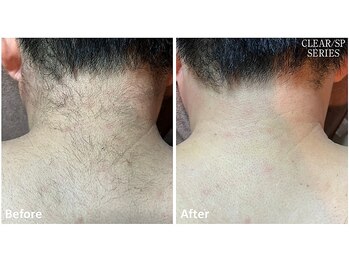 セラス(CERAS)/男性の襟足脱毛