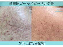 リメイククリニカルビューティー(Remake clinical beauty)/気になる赤み