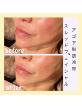 アールアンドエス(R&S)/あご下脂肪冷却×スレッド