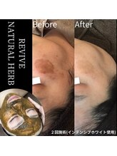 ホワイトビューティーラボ(White Beauty Lab)/次世代ハーブピーリング