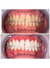 コナホワイトニング 神保町/6ヶ月ビフォア