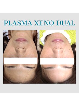 ビーダブリュー(BW...)/シミも根本からアプローチ☆