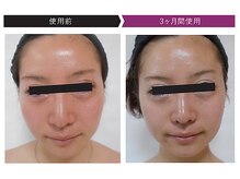 パーフェクトフェイスビューティー 梅田店(PERFECT FACE BEAUTY)/ディレイアコスメ（3種）使用