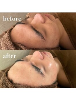 ルナージュ 三田店(LUNARLE)/メンズも♪REVIハーブピーリング