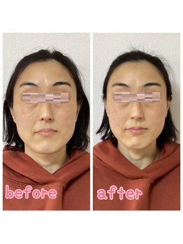 小顔整体 優/エラはりが気になる方も☆
