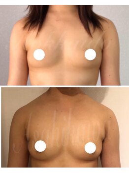 美人バスト 旭川店/バストアップ◇症例◇