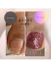 巻き爪ケアフット