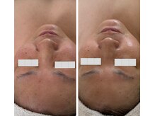 リュミエール(Lumie're)/乾燥ケア