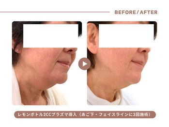 イエス マイサロン(yes My Salon)/レモンボトル施術例