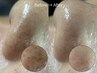 毛穴づまり・ごわつき/毛穴洗浄+毛穴引き締め美容液導入+デコルテ計100分
