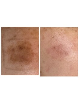 ノーファンデの樹 健康の丘の写真/医師監修★話題のシミケア◎塗るだけで気軽にできる痛みの少ない施術♪気になるシミを集中ケア！