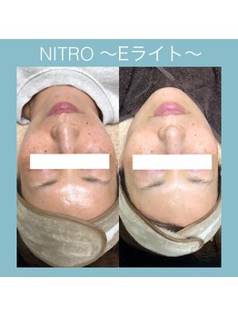 ビーダブリュー(BW...)/驚きの効果　Eライト　施術1回