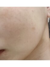 アグライア(Aglaea)/シミケア/before