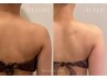 頑固な首肩こりに☆次世代インディバウィンバックで華奢肩に15000→9800