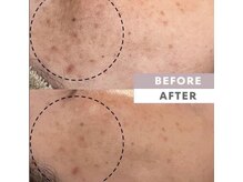 【肌質改善】次世代エイジングケア★全ての肌悩みアプローチ治癒