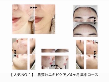 まぁ ま 西葛西店/ニキビ肌荒れでお悩みの方へ ☆