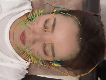 ソラナ(Solana)/美容鍼【100本】百華鍼