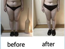 カーム(Calm)/脂肪冷却