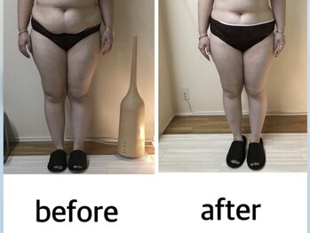 カーム(Calm)/脂肪冷却