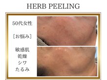 ロージー(ROSY)/ハーブピーリング/阿南/徳島