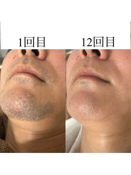 フュチュール(futur)の写真/痛みの少ないヒゲ脱毛で清潔感を！高評価プラズマエステで見違える輝きを★
