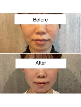 東京デトックス/インディバフェイシャル4回