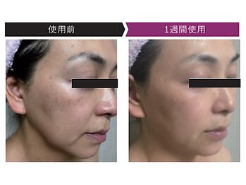 パーフェクトフェイスビューティー 梅田店(PERFECT FACE BEAUTY)/ディレイアコスメ（1種）使用