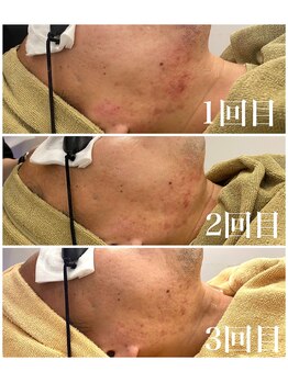 ミシェル(Michelle)/おヒゲ脱毛と高濃度導入美容液