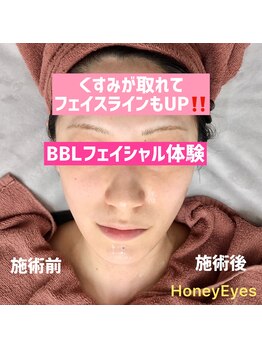 ハニーアイズ(Honey Eyes)/BBLフェイシャル☆