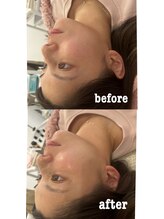 マホロバ(mahoroba)/ララピール×美容鍼