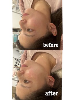 マホロバ(mahoroba)/ララピール×美容鍼