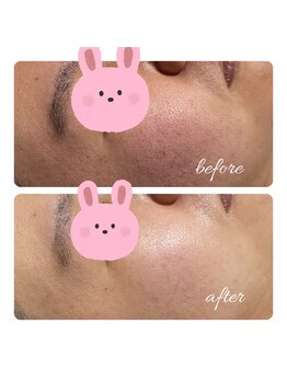 ヒラキヒミ。/毛穴洗浄エステ+上半身