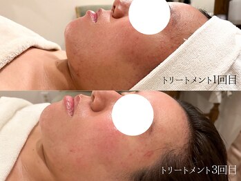 クリアヒーリングサロン/マッサージと肌質改善の効果