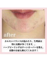 アルムダアクア 天王寺店(Aleumda AQUA)/ハーブピーリング/大阪/天王寺