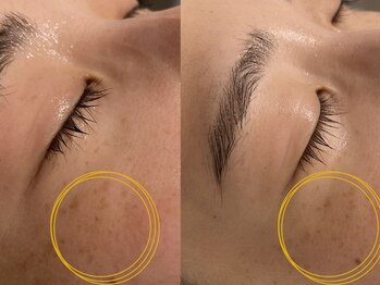 シェリー(CHERIE)/光フォトコース