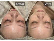 エナ(ENA)/エイジングケア　Before→After